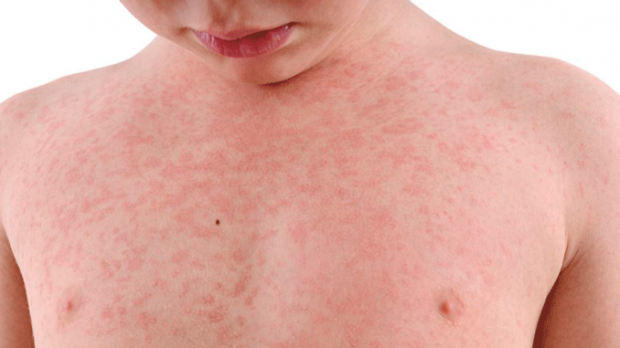 measles