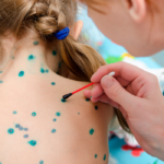 Семеро детей Гиагинского района заболели ветрянкой